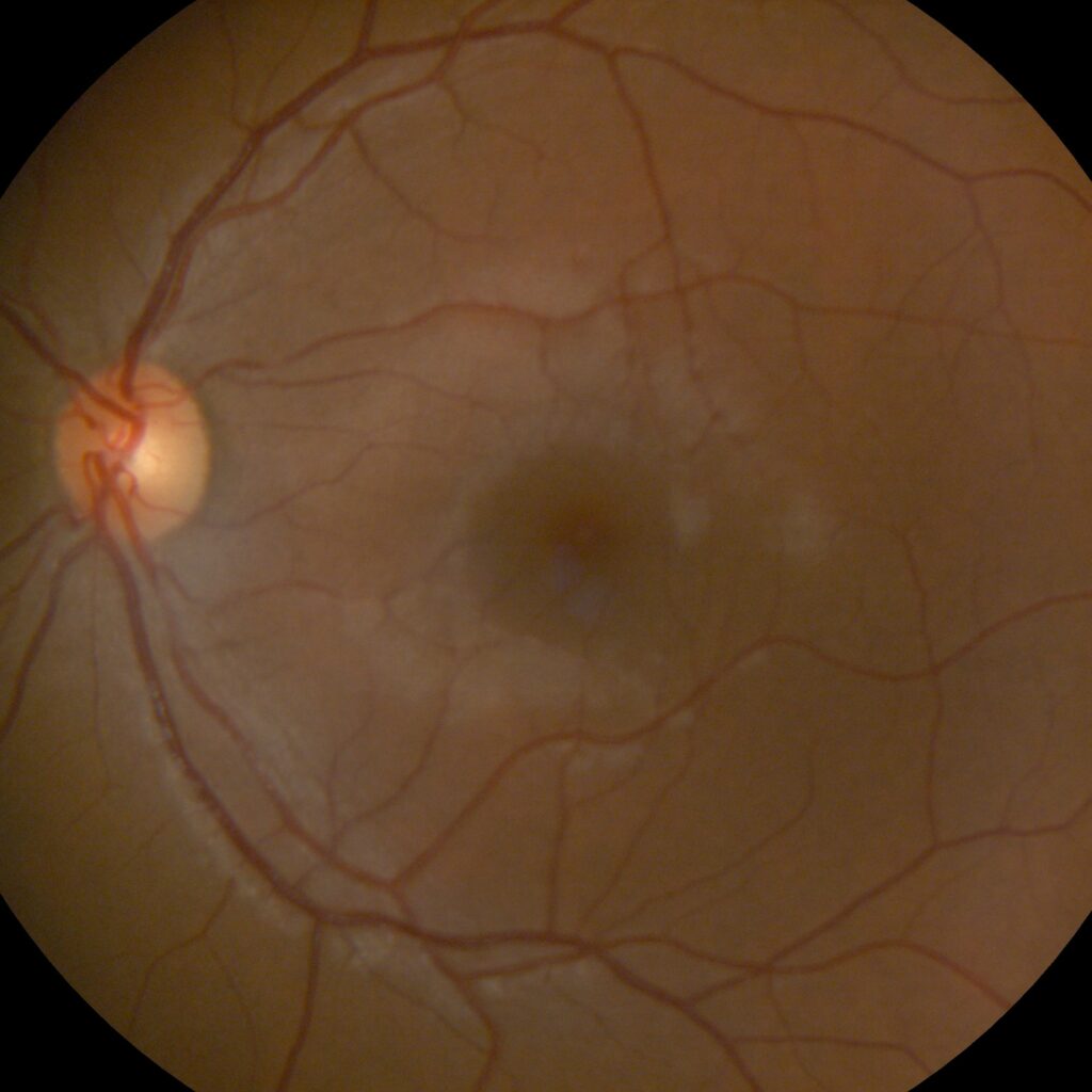 retinografía-servicios-de-vision-zenvision Retinografía servicios de vision